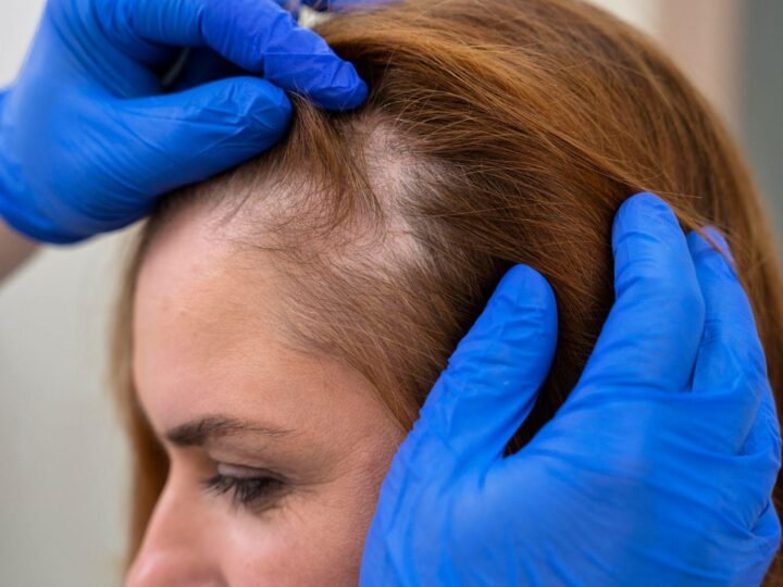 Cabelo afinando aos poucos pode ser sinal de alopecia androgenética