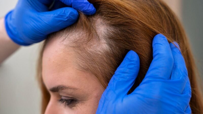 Cabelo afinando aos poucos pode ser sinal de alopecia androgenética