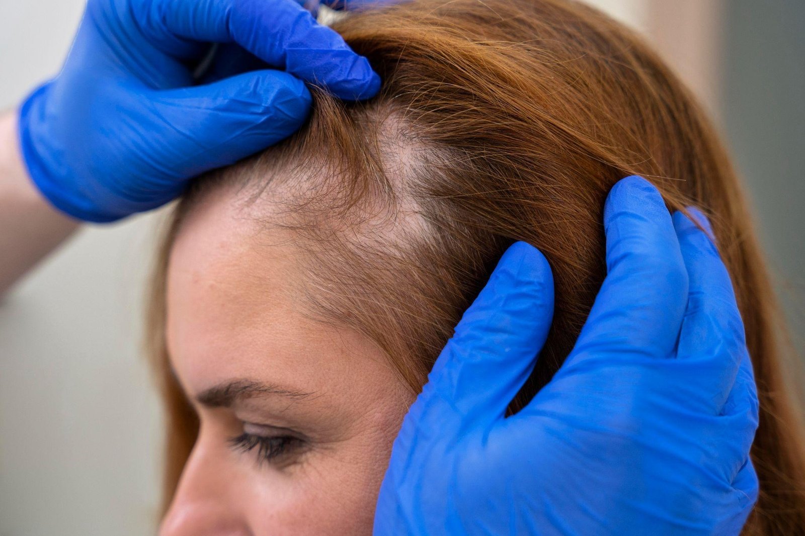 Cabelo afinando aos poucos pode ser sinal de alopecia androgenética